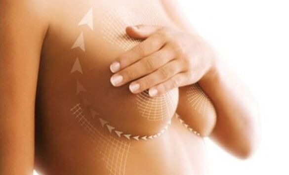 levantamento de sutura para o aumento do peito