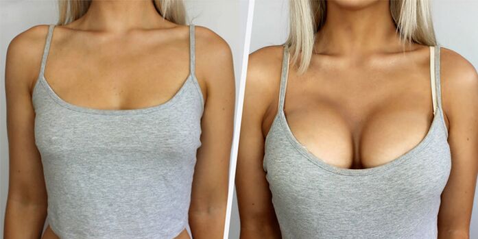 antes e despois da cirurxía plástica para o aumento do peito
