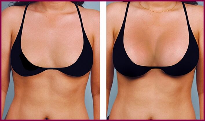 antes e despois do aumento mamario con graxa