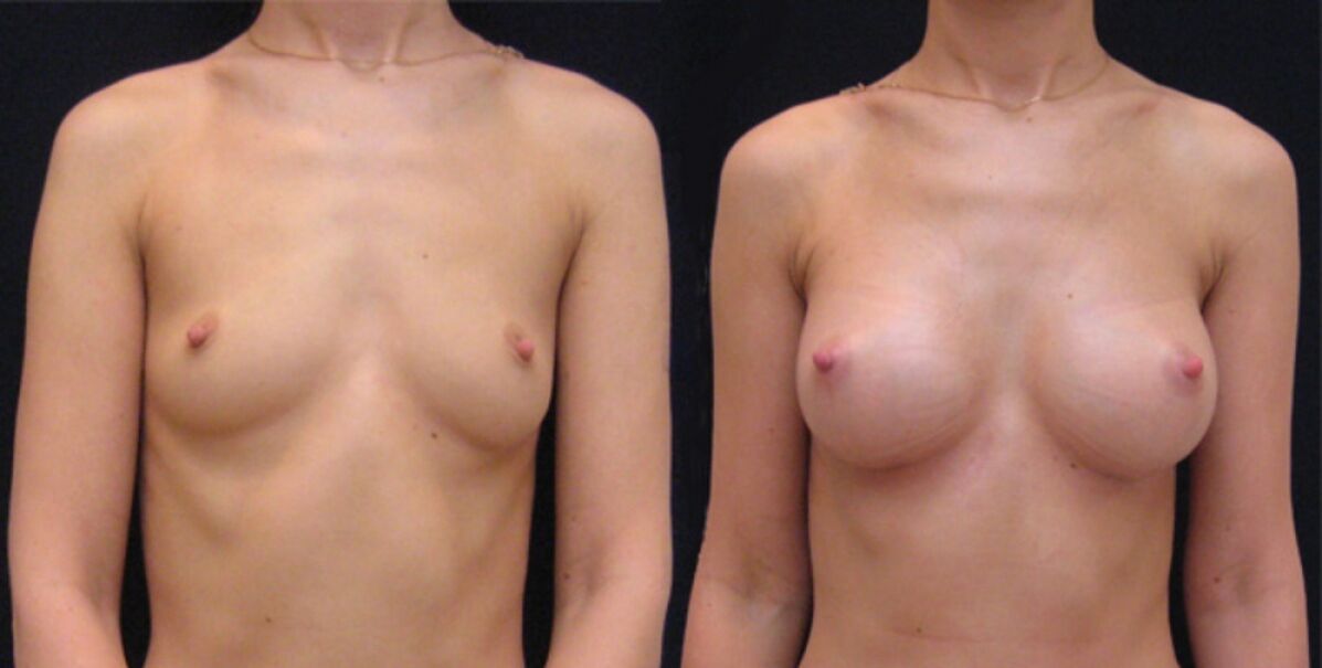 mama antes e despois do aumento endoscópico