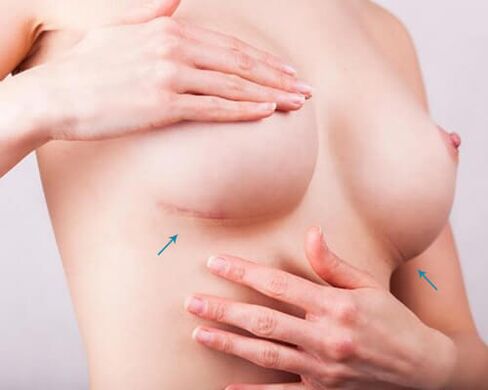 Ampliación de mama con implantes