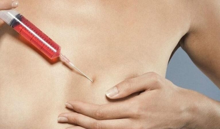 Aumento mamario con inxeccións de ácido hialurónico