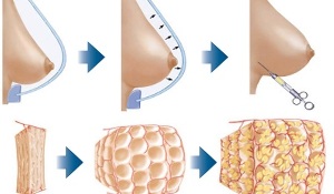 como se realiza o procedemento de aumento de mama con graxa