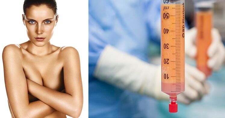 lipofilling como método de aumento de mama