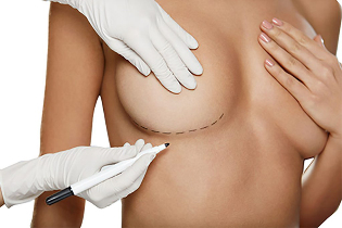 Marcado cun marcador antes da cirurxía de aumento de mama